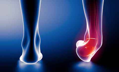 Skręcenie stawu skokowego